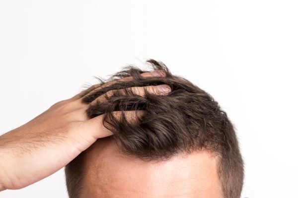 Minoxidil