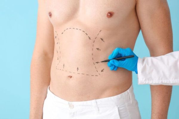 ¿Es posible una liposucción sin cirugía en el hombre?
