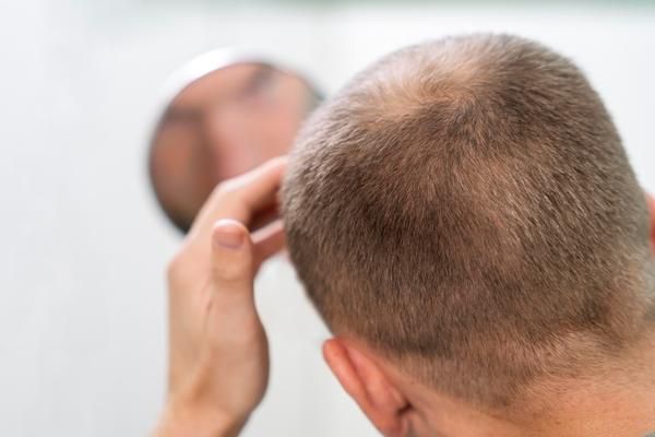 Minoxidil, ¿qué es y cómo ayuda a la caída del pelo? 2