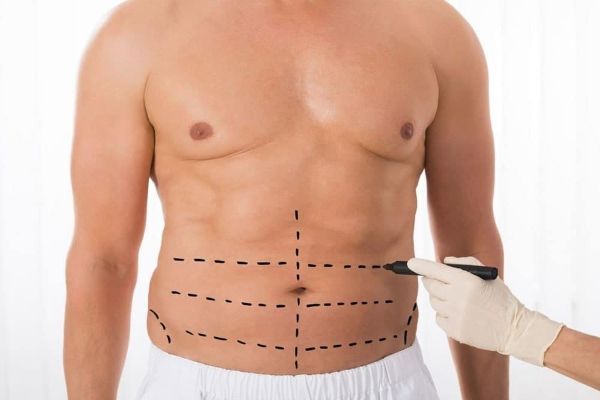 Lipoescultura y liposucción, ¿qué son y diferencias? 2
