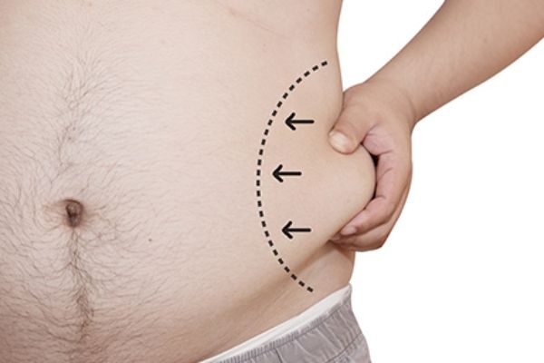 Lipoescultura y liposucción, ¿qué son y diferencias? 1