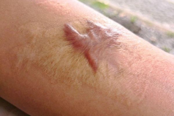 Cicatrices queloides, ¿qué son y cómo quitarlas?