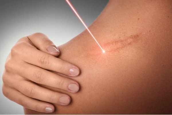 Cicatrices queloides, ¿qué son y cómo quitarlas? 1