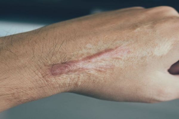Cicatrices queloides, ¿qué son y cómo quitarlas?