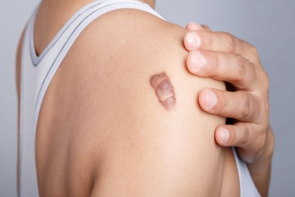 Cicatrices queloides, ¿qué son y cómo quitarlas? 2
