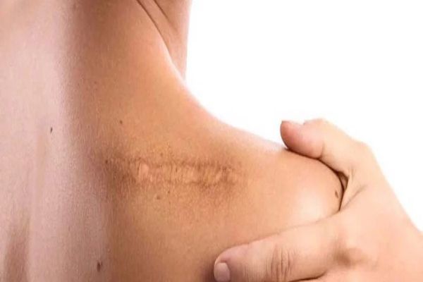 Cicatrices queloides, ¿qué son y cómo quitarlas? 6