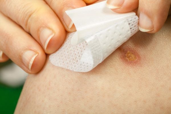 Cicatrices queloides, ¿qué son y cómo quitarlas? 5